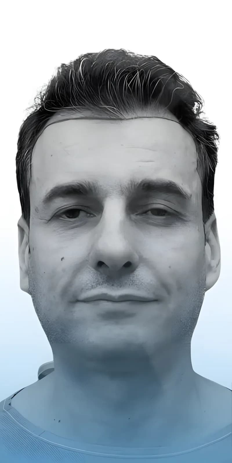 Before hair transplant